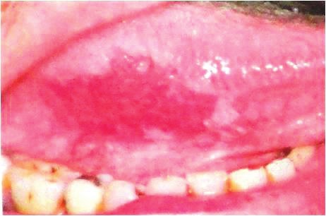 Эритроплакия