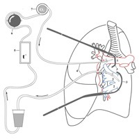 Регионарные химиоперфузии