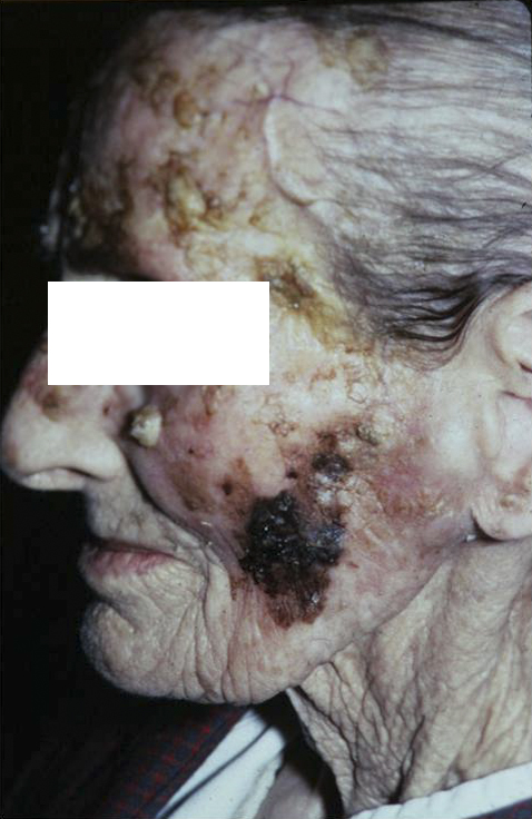 меланоз Дюбрея