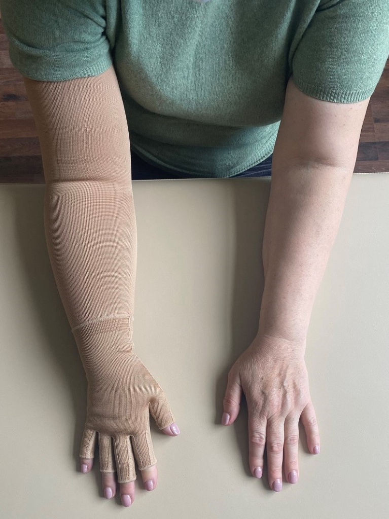 Лимфедема лечение Лимфедема лечение