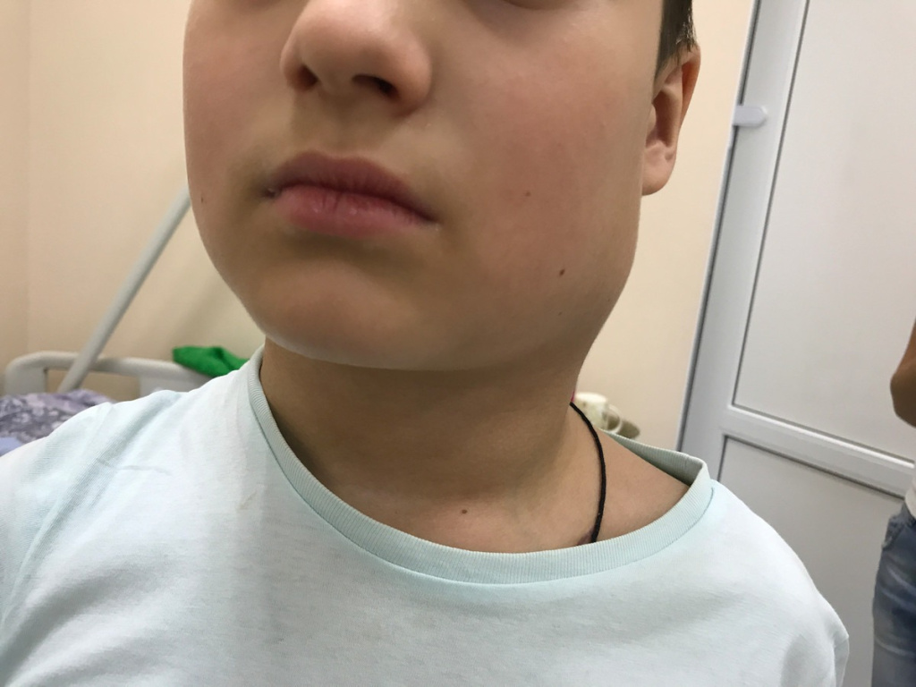 Поражение шейных лимфатических узлов