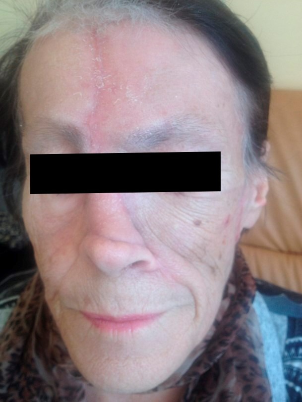 Состояние после хирургического лечения