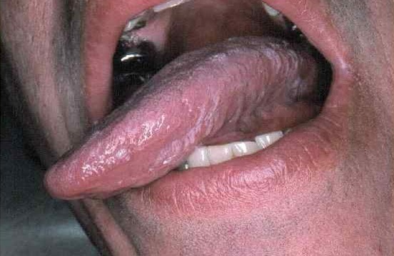 Лейкоплакия