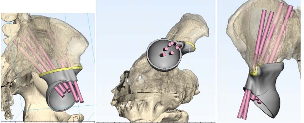 3D-моделирование операции
