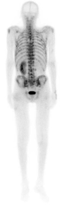 Остеосцинтиграфия