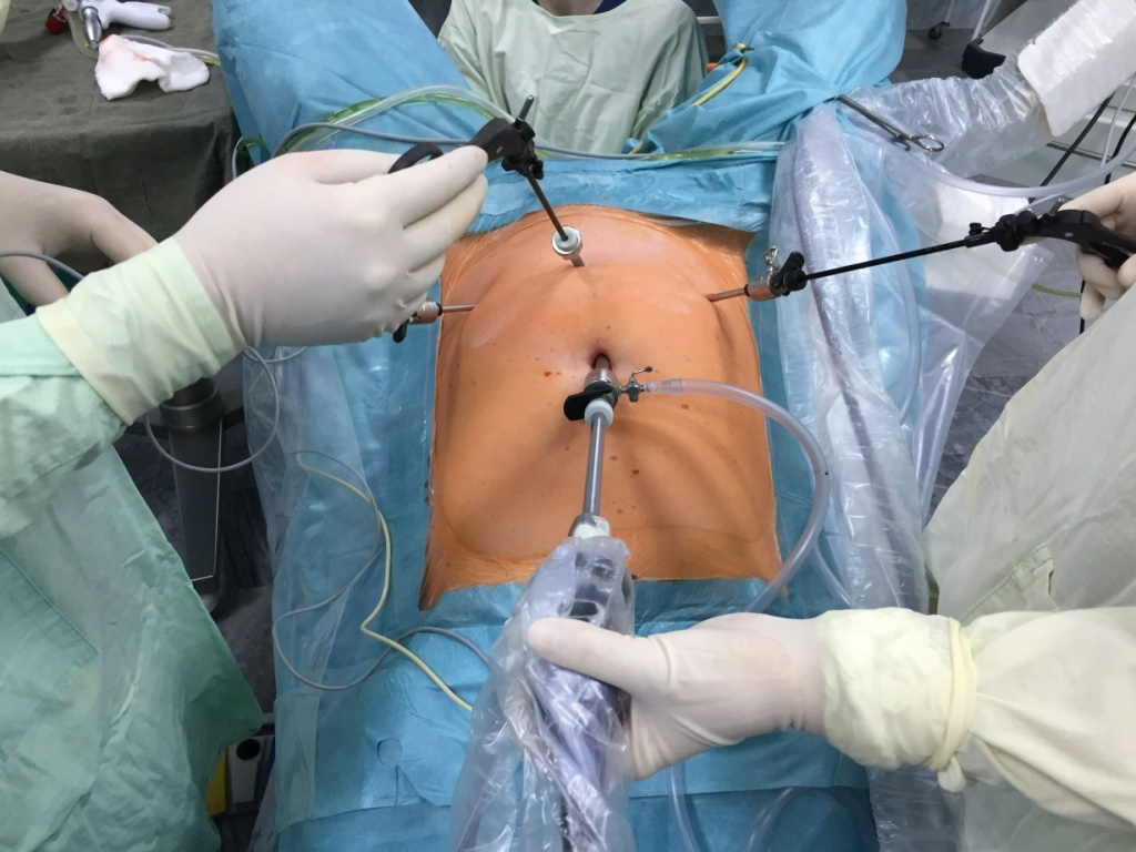 Типичное положение троакаров