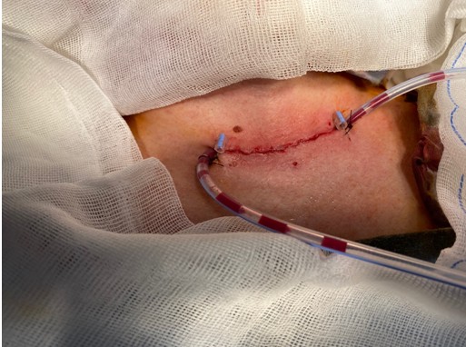 дренажные трубки дренажные трубки