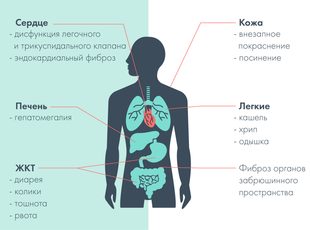 карциноидный синдром