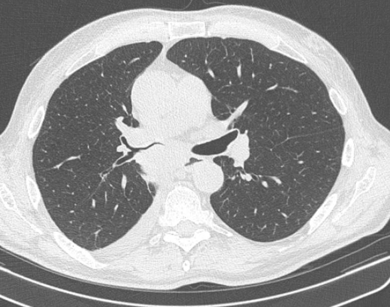 Рак легкого