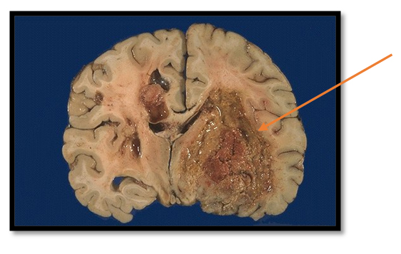 Глиобластома Глиобластома