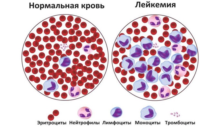 Лейкоз Лейкоз