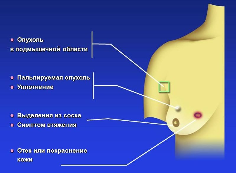 Признаки и симптомы рака молочной железы