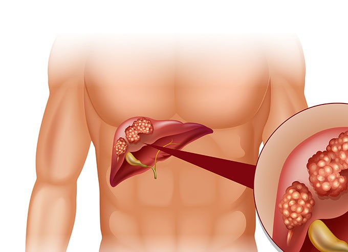 Диагностика рака печени