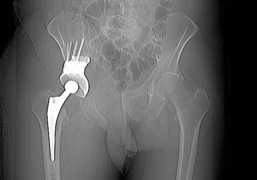 Эндопротезирование