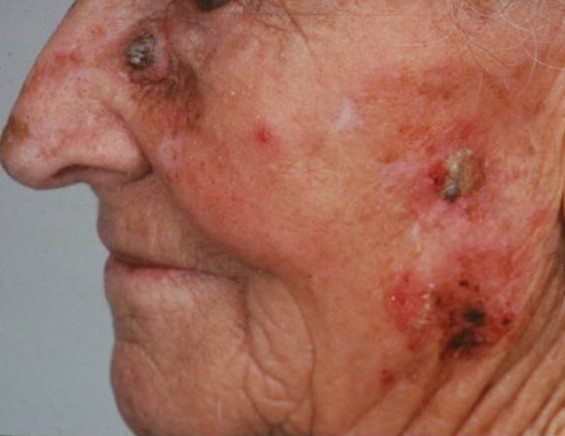 актинический кератоз