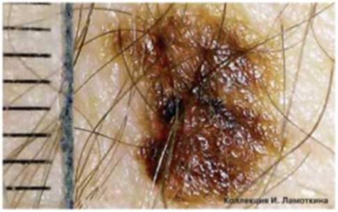 атипичные (диспластические) невусы