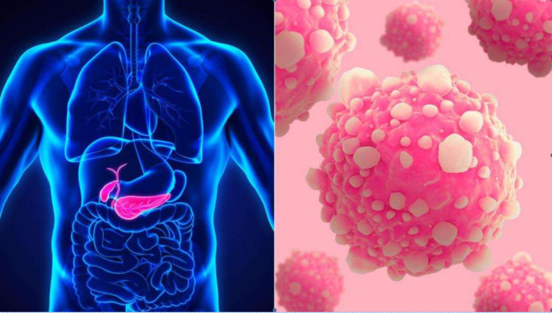 нейроэндокринные опухоли поджелудочной железы
