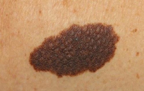 Врожденный средний меланоцитарный невус