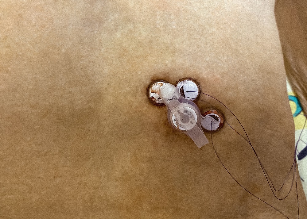 чрескожная эндоскопическая гастростомия