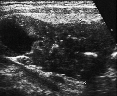 УЗИ мягких тканей шеи УЗИ мягких тканей шеи