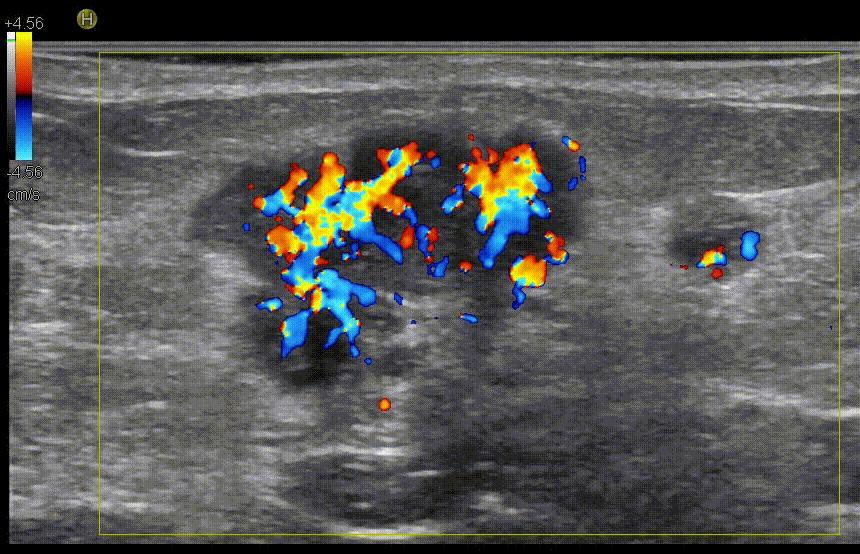 Рис.8 Эхограмма гиперваскулярного рака молочной железы