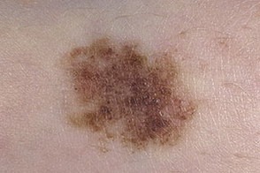 Диспластический невус