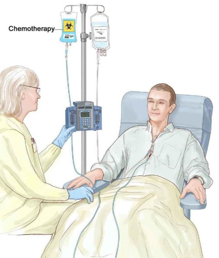 Схематичное изображение процедуры внутривенной инъекции химиопрепаратами Схематичное изображение процедуры внутривенной инъекции химиопрепаратами