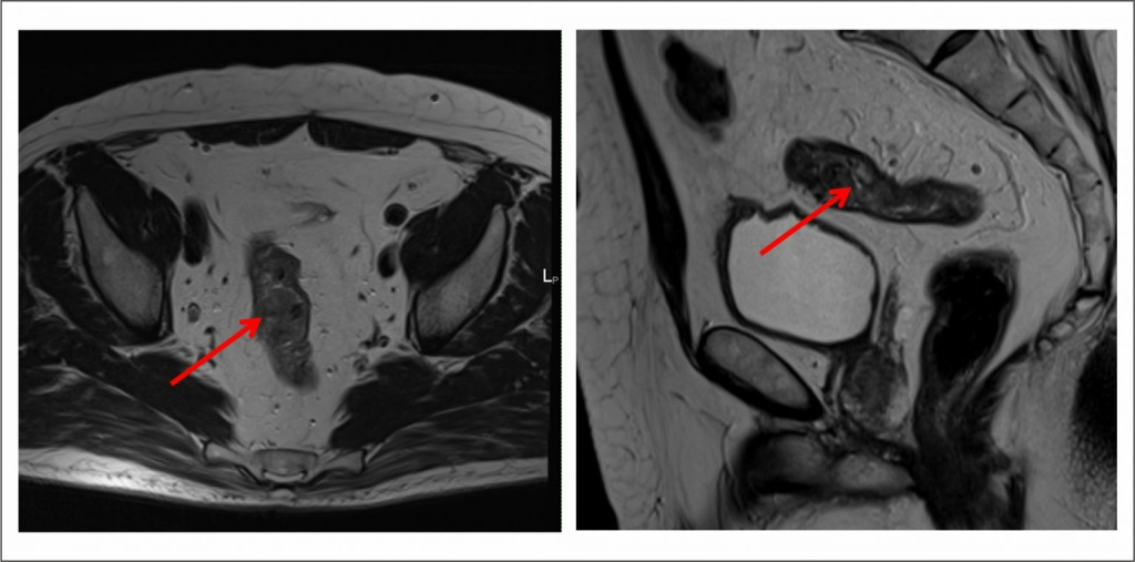 Рак прямой кишки