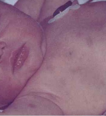 поражение кожи и слизистых оболочек проявляется в виде лейкемидов, некроза, гингивита и стоматита поражение кожи и слизистых оболочек проявляется в виде лейкемидов, некроза, гингивита и стоматита