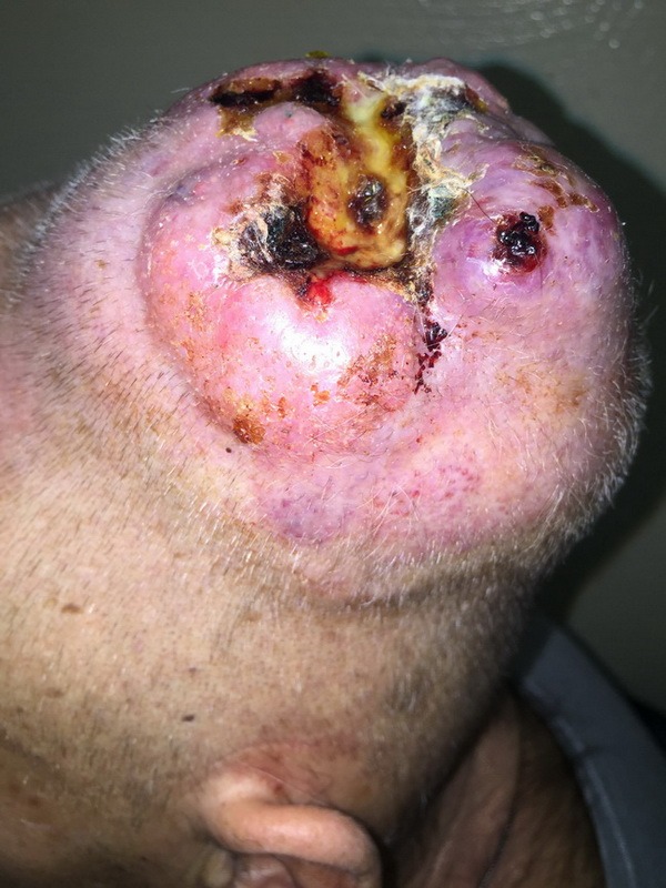 саркома мягких тканей