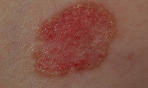 Рак кожи: симптомы, диагностика, лечение | Как выглядит онкология кожи