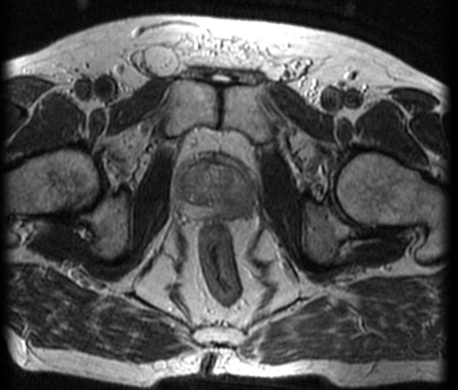 МРТ (Т2-взвешенные изображения)