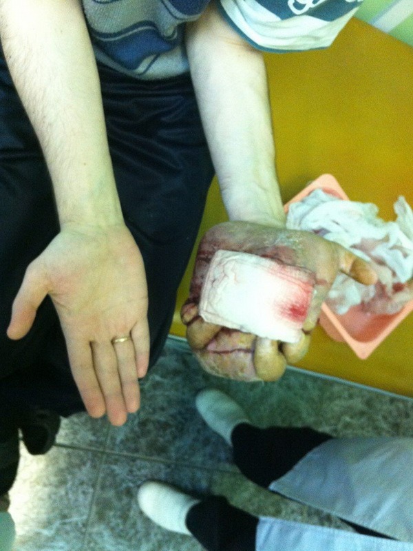 саркома мягких тканей