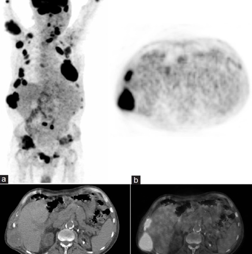 Рис. 7: ПЭТ/КТ и визуализация бурых опухолей при гиперпаратиреозе. Ограниченные данные свидетельствуют о высокой чувствительности, но низкой специфичности ПЭТ/КТ в диагностике бурых опухолей