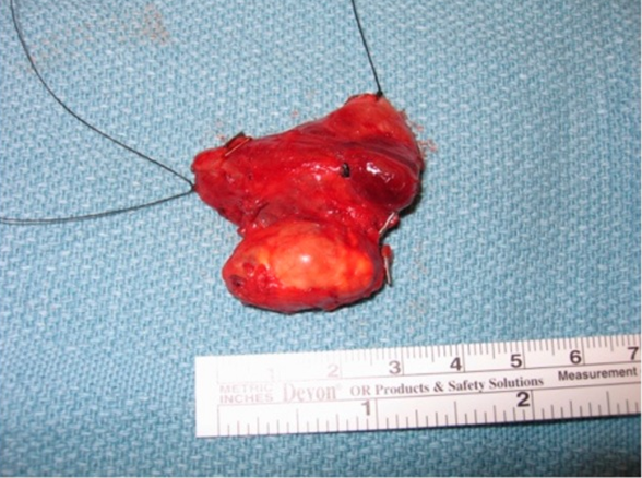 удаление паращитовидных желёз удаление паращитовидных желёз