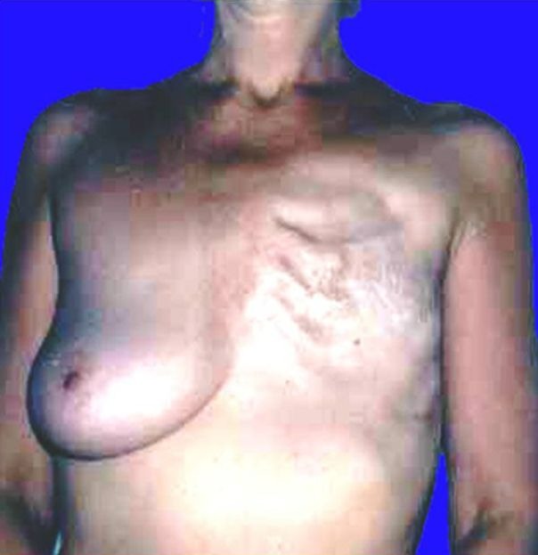 Радикальная мастэктомия