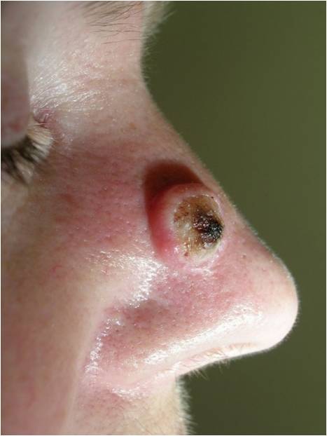 кожный рак in situ