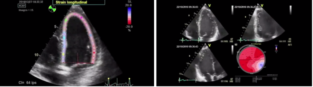 Измерение глобальной продольной деформации (global longitudinal strain или GLS)