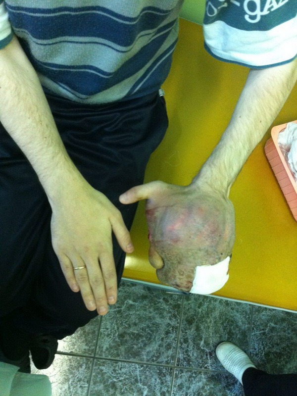 саркома мягких тканей