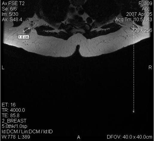 МРТ-диагностика рака молочной железы