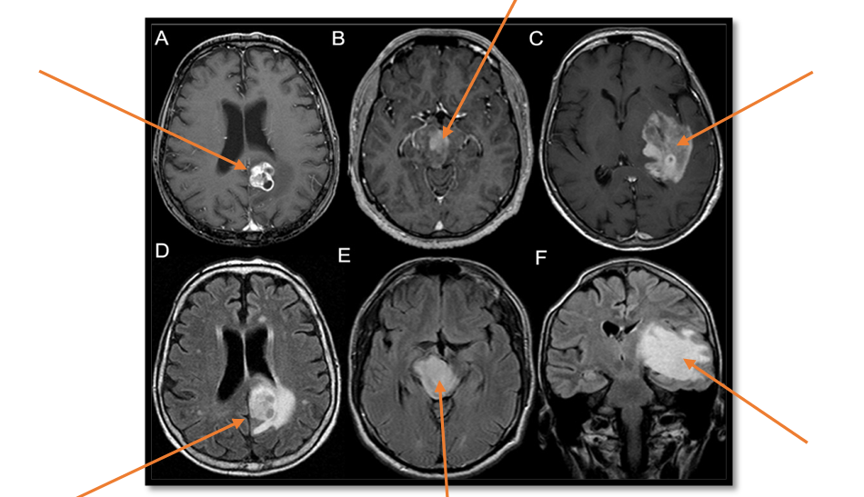 Fiechter M., Hewer E., Knecht U., Oertel M.F. Adult Anaplastic Pilocytic Astrocytoma − A Diagnostic Challenge? A Case Series and Literature Review – 2016 Fiechter M., Hewer E., Knecht U., Oertel M.F. Adult Anaplastic Pilocytic Astrocytoma − A Diagnostic Challenge? A Case Series and Literature Review – 2016