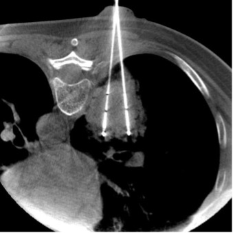Криоабляция метастаза
