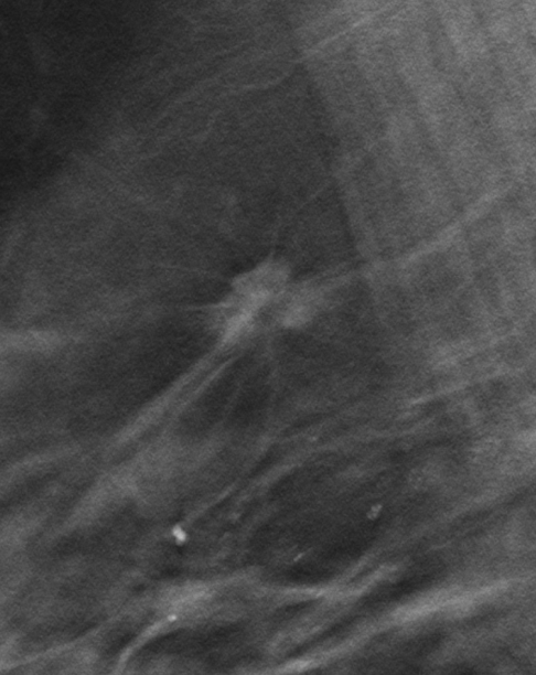 Рис.3 Томосинтез: рак правой молочной железы