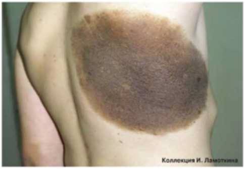 Невусы меланоцитарные