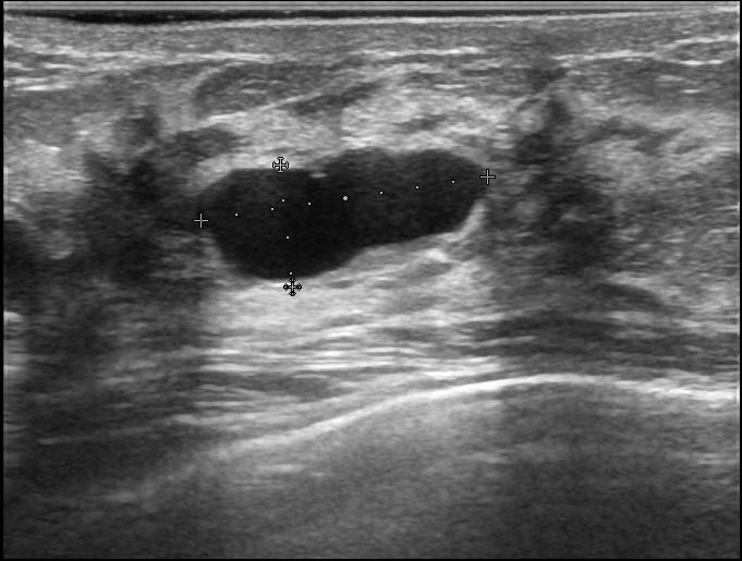 Рис.6 Эхограмма кисты молочной железы