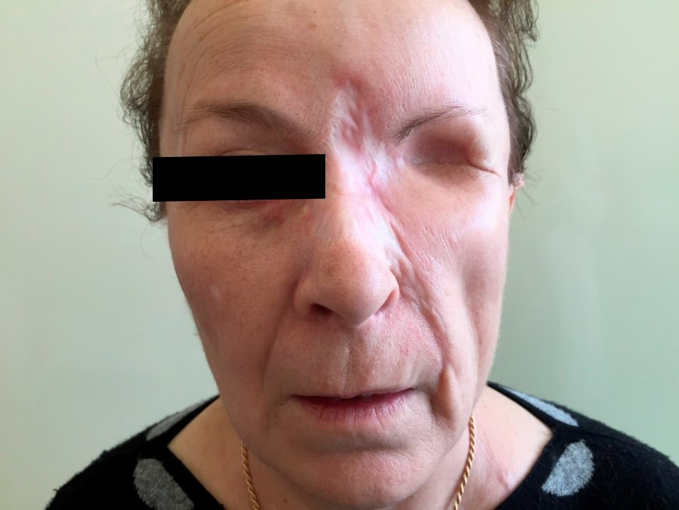 Базальноклеточный рак кожи