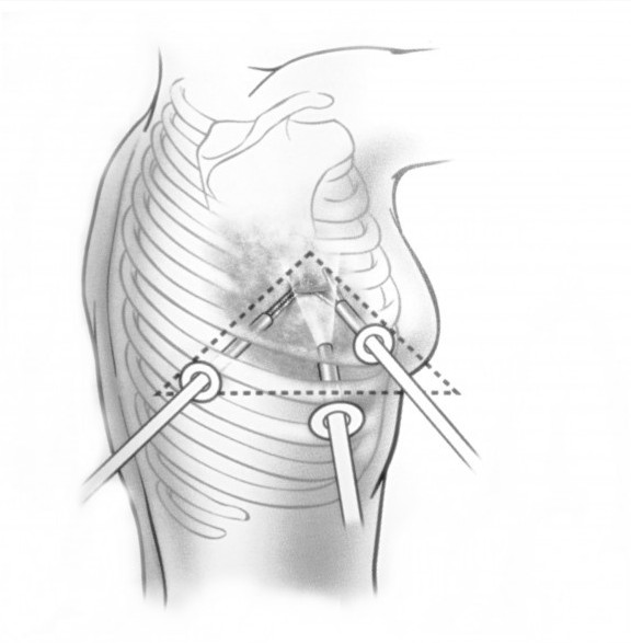 Хирургический метод Хирургический метод