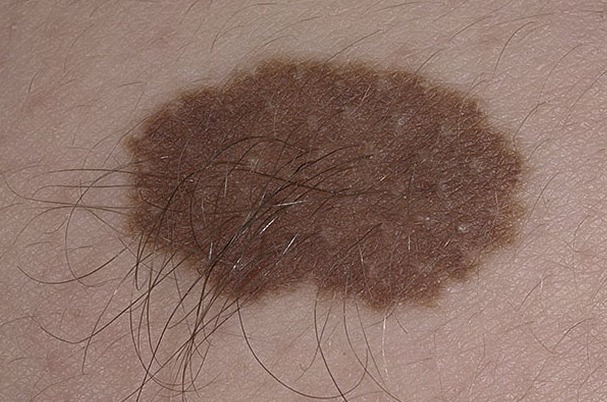 Пограничный невус