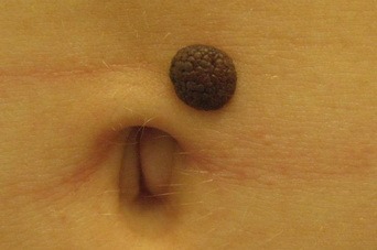 Веррукозный невус