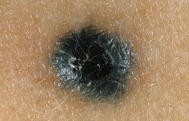 Голубой невус